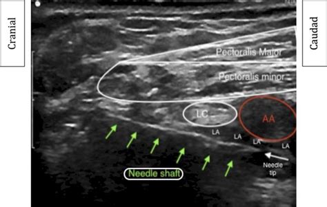 Ultrasound Guided Infraclavicular Brachial Plexus Block Wfsa Resources