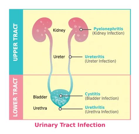 Lower Urinary Tract Symptoms Reduced Risk By Drinking