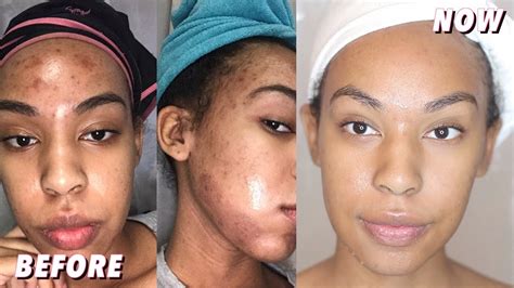 Current Skin Care Routine How To Get Rid Of Acne And Hyperpigmentation