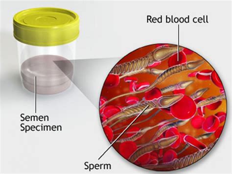 Blood In Semen Or Hematospermia Or Hemospermia