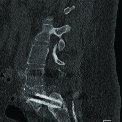 Standing Posteroanterior And Lateral Radiographs Left Lumbosacral