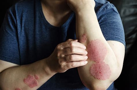 Dermatological Skin Disease Psoriasis Eczema Dermatitis Allergies Skin