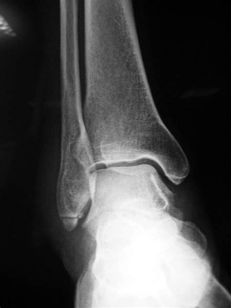 A Patient With An Avulsion Fracture Of The Tip Of The Lateral Malleolus