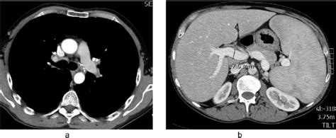 A Ct Scan Of The Thorax With Contrast Enlarged Lymph Nodes In