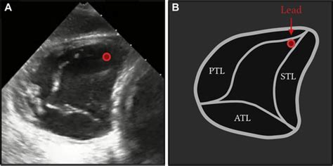 Prevention Of Pacemaker Lead Induced Tricuspid Regurgitation By