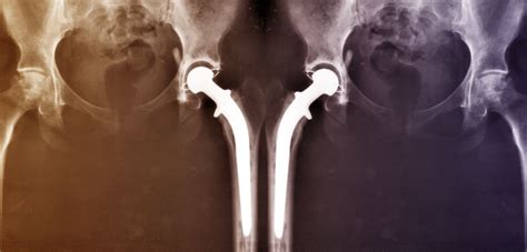 Biomet Uk Withdraws Flawed Hip Shell Orthopedics This Week