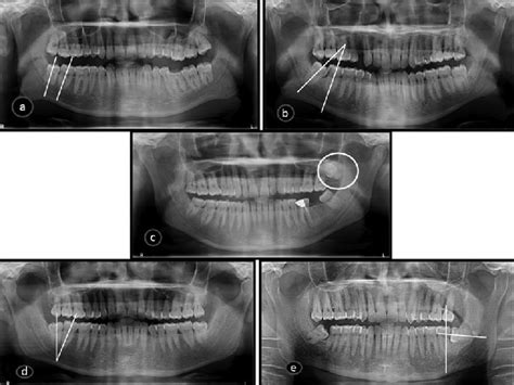 Opgs Showing A Vertical Impaction 48 B Mesioangular Impaction 48