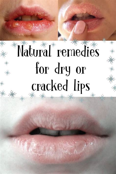 Cracked Lips Natural Remedies For Dry Or Cracked Lips Cracked Lips
