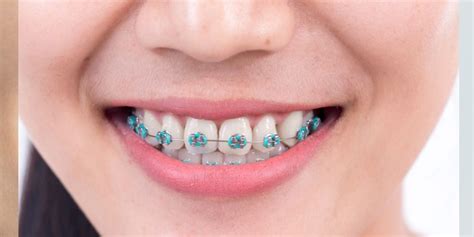 If you always have a lot of pain after your braces are adjusted, talk to your orthodontist about it; How Long Will I Need Braces Quiz - BestFunQuiz