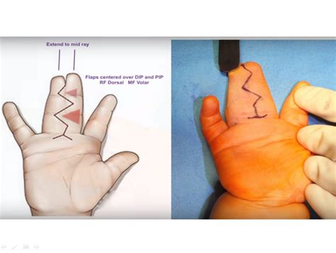 Release Of The Fingers In Syndactylywebbing —