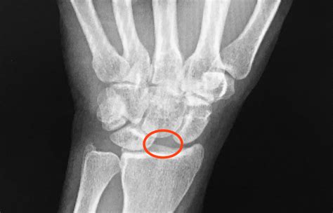 Wrist Osteoarthritis Scapholunate Advanced Collapse Hand Surgery Source