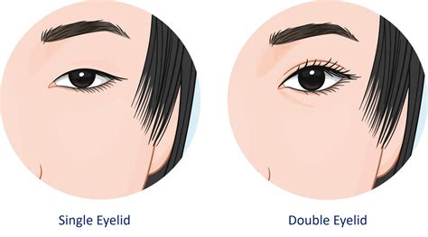 Incisional Vs Non Incisional Double Eyelid Surgery In Singapore Dream Plastic Surgery