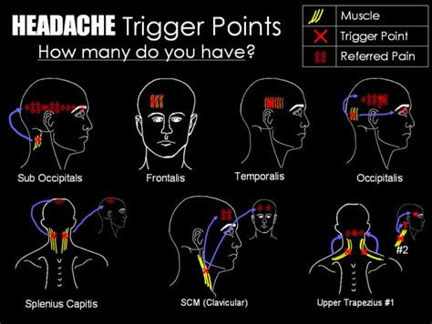 17 Best Images About Trigger Points Massage On Pinterest Massage