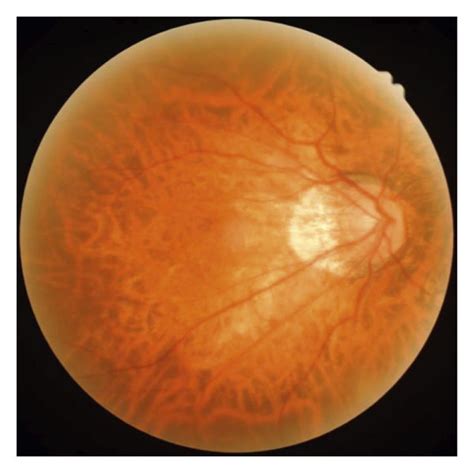 Representative Images Of Eyes With Early Dry Type Myopic Maculopathy A