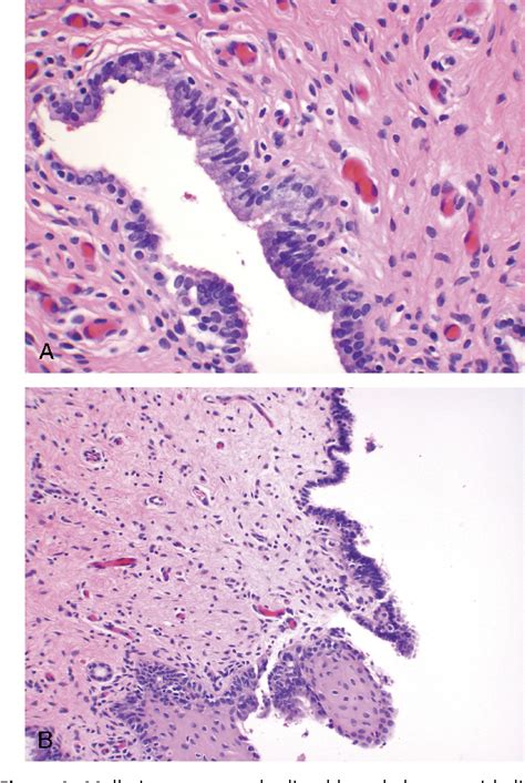 Figure 1 From Vaginal Cysts A Pathology Review Semantic Scholar