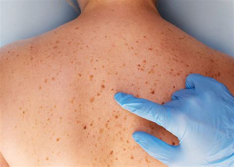 Moles Symptoms And Treatments Dermatology Inc