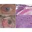 Histologic Changes In A Squamous Cell Carcinoma Of Conjunctiva 