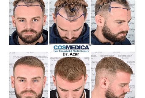 Mal sehen wo das alles enden wird. Haartransplantation Türkei vorher nachher | Dr. Acar
