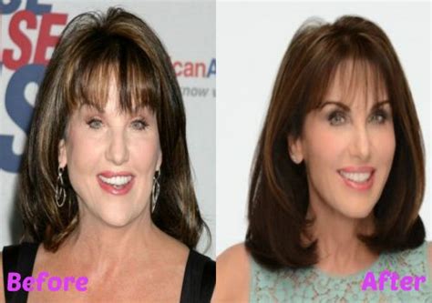 Robin has authored two books what's age got to do with it. Robin Mcgraw facelift | Facelifts Before & After ...