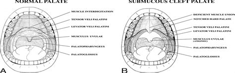 Transillumination Of The Occult Submucous Cleft Palate Journal Of