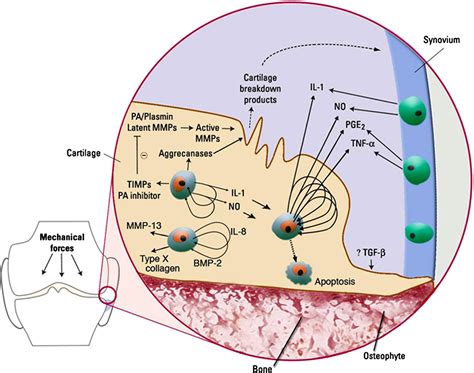 Current Concepts In The Pathogenesis Of Osteoarthritis Osteoarthritis