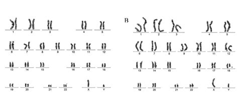 Normal And Abnormal Karyotypes