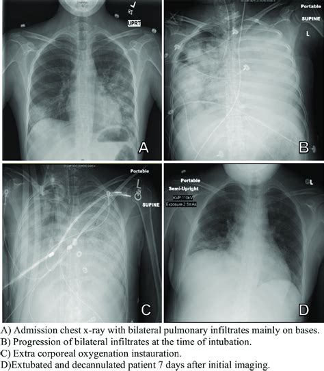 A Admission Chest X Ray With Bilateral Pulmonary Infiltrates Mainly