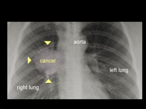Low Dose Ct Lung Cancer Screening Update