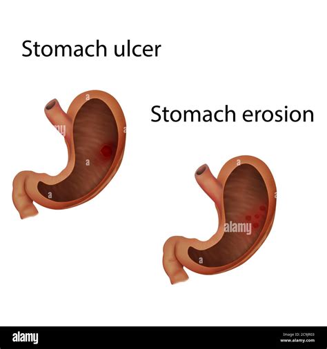 Stomach Erosion Hi Res Stock Photography And Images Alamy