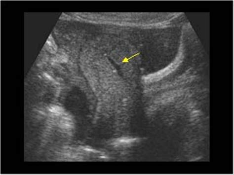Gynaecology 32 Adnexa Case 325 Ectopic Pregnancy Ultrasound Cases