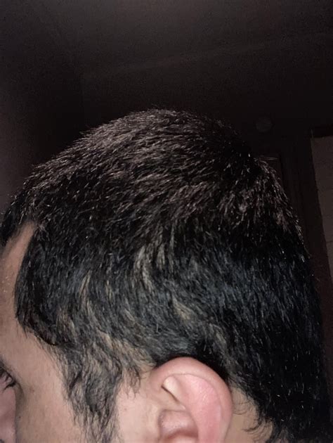 19m Retrograde Alopecia Have Had It Like This As Long As I Can
