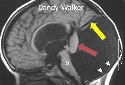 Dandy Walker Syndrome Dandy Walker Malformation