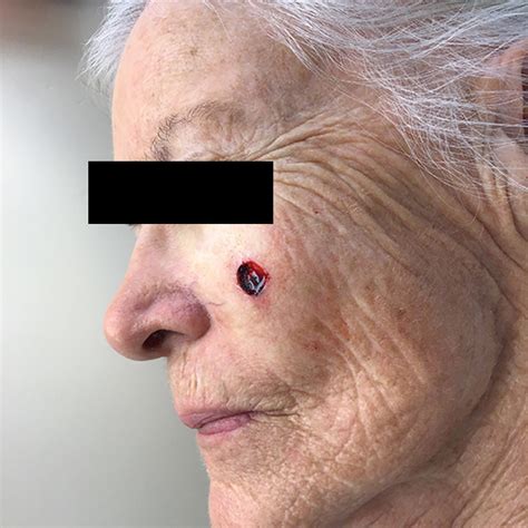 Mohs Surgery Before And After Case 7 Phoenix Surgical Dermatology Group