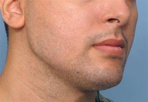 Male Chin Implant And Custom Jaw Angle Implant Result Oblique View 2 Dr