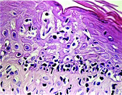 Mycosis Fungoides Epidermotropism Of Convoluted Lymphocytes And
