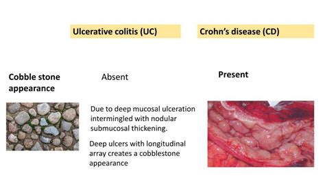 Ulcerative Colitis Vs Crohns Disease Pathology Made Simple