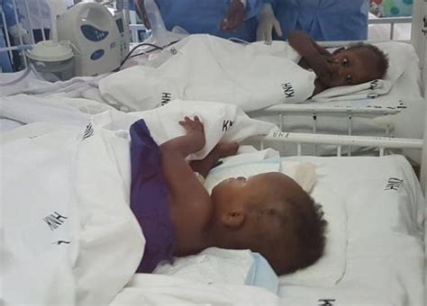 Hotandspicygist Conjoined Twins Meet Each Other After Surgery To