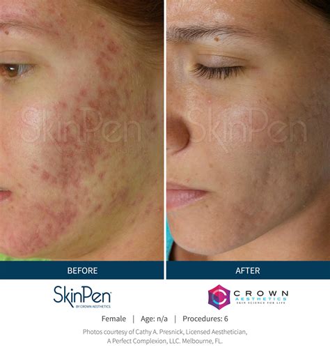 Skinpen Microneedling Fight Facial Acne Scars Crown Aesthetics
