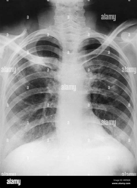 X Ray Of Hodgkins Lymphoma Stock Photo Alamy