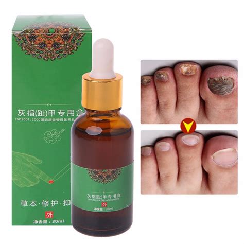 30ml Fungal Nail Treatment Essence Repair Toe Nails Finger Anti Fungus