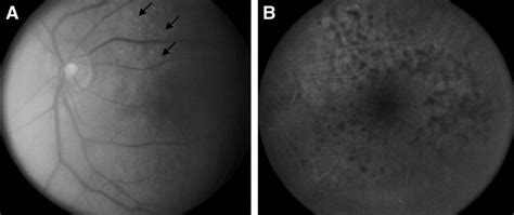 Primary Testicular And Intraocular Lymphomas Two Case Reports And A