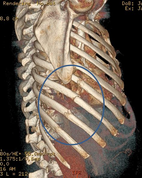 How To Help A Broken Rib Classeconomy3