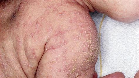 Sheba medical center specialist begins clinical trial of ivermectin, hoping it could shorten the duration of the infection to a few days. Scabioral (vorerst) wieder lieferbar | APOTHEKE ADHOC