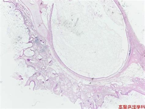 Kmu Pathology Lab《slide 38》dermoid Cyst Ovary