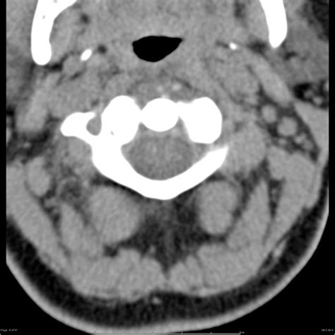 Retropharyngeal Abscess Radiology Case Radiology