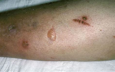 Diabetic Blisters Pictures 1 Symptoms And Pictures