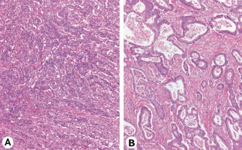 Histomorphologic Appearance Of The Primary Gastric Carcinoma A And A