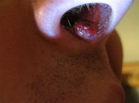 We did not find results for: Nose Piercing Bump, Inside Nose, Infection, Keloid, Popped ...