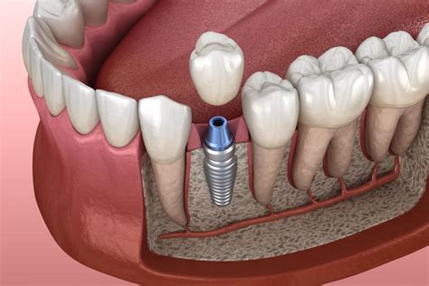 En Qu Consiste La Osteointegraci N De Los Implantes Dentales