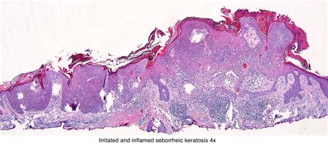Pathology Outlines Seborrheic Keratosis